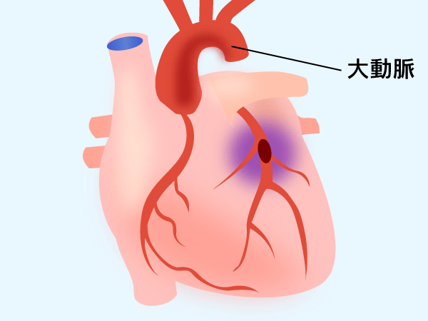 狭心症・心筋梗塞