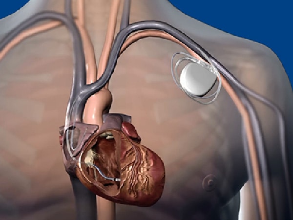 ペースメーカー を 入れる 病気