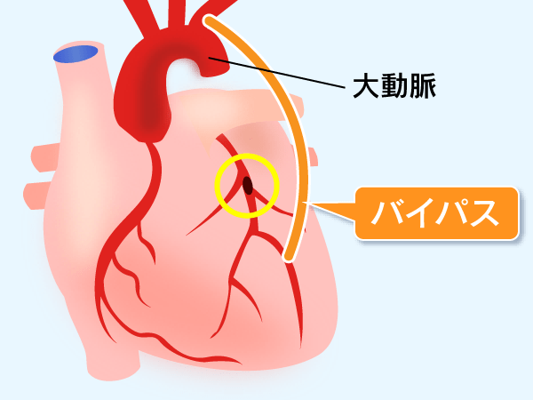 Cabg 冠動脈バイパス手術 当院で行う治療 検査 診療案内 心臓病センター榊原病院